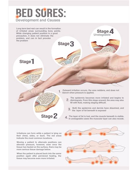 Bed Sore Stages: Patient Guide :: Behance