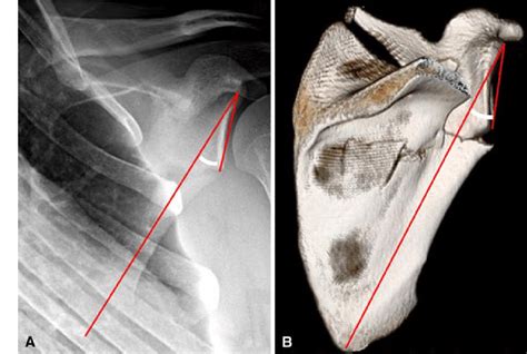 Scapula Fractures - Trauma - Orthobullets