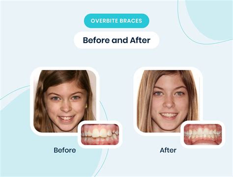 A Complete Guide to Overbite Braces