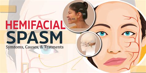 Hemifacial Spasm: Symptoms, Causes, and Treatments