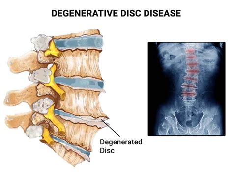 Thoracic Degenerative Disc Disease NJ & NYC