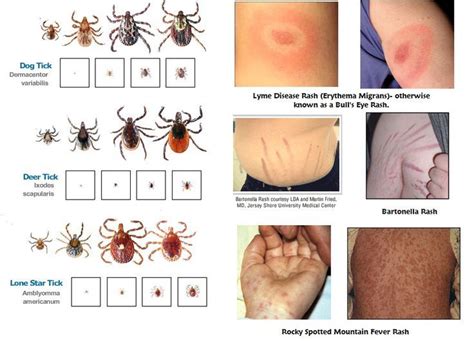 Ticks, Tick rash, Tick bite