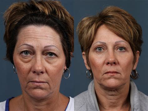 Upper and Lower Blepharoplasty