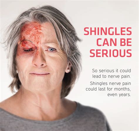 Shingles face | Mandurah Medical