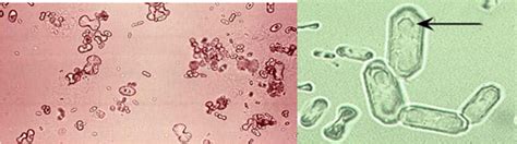 Calcium Oxalate crystals (monohydrate) | Medical Laboratories