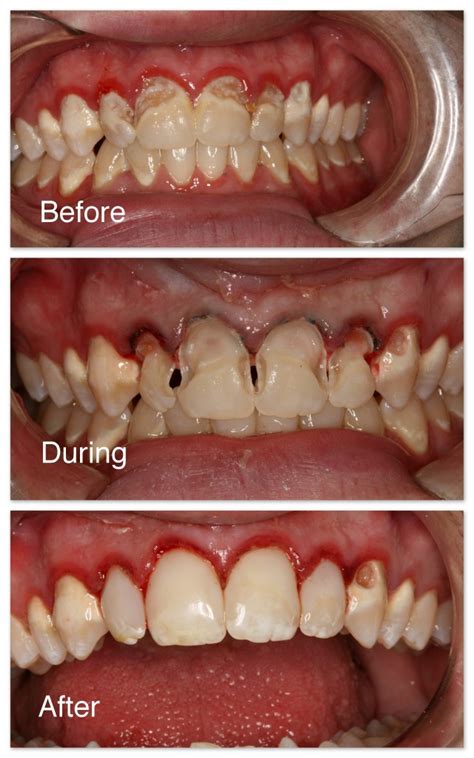 Tooth Colored Fillings Gallery - Hosner Family Dentistry