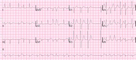 Dr. Smith's ECG Blog: Atrial fibrillation with RVR: use POCUS to assess ...