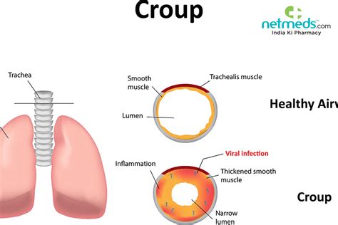 Croup: Causes, Symptoms And Treatment