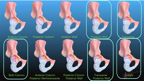 Acetabular Fractures | UW Emergency Radiology