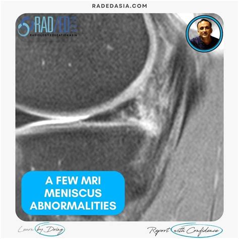 A FEW MRI MENISCUS ABNORMALITIES: MENISCUS TEAR, INTRA MENISCAL CYST ...