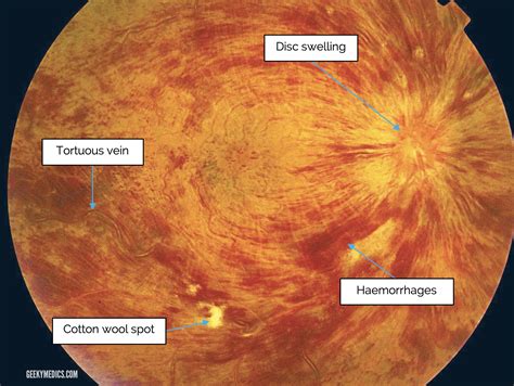 Fundoscopic Appearances of Retinal Pathologies | Geeky Medics