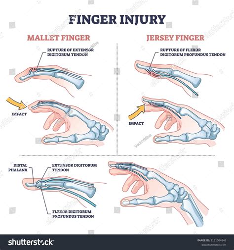 60 Flexor Tendon Hand Stock Vectors, Images & Vector Art | Shutterstock