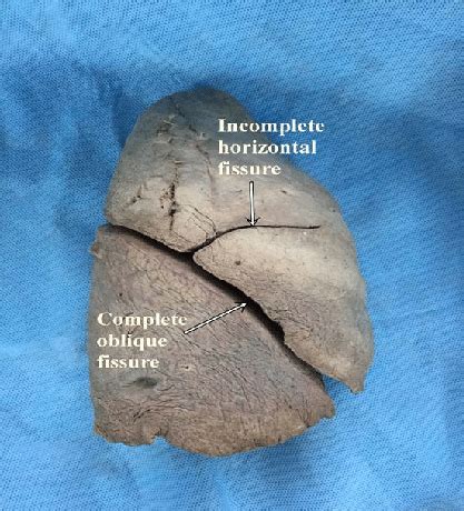 Right lung showing complete oblique fissure and incomplete horizontal ...