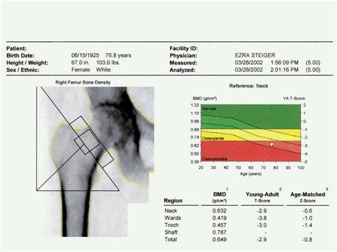 Osteoporosis. La epidemia silenciosa del siglo XXI | Clínica ...