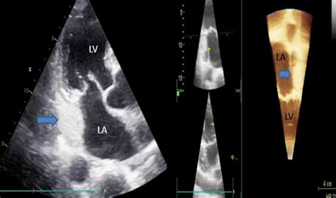 Persistent left superior vena cava on 2D and 4D echocardiography after ...