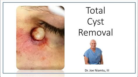 [DIAGRAM] Diagram Of Sebaceous Cyst - MYDIAGRAM.ONLINE