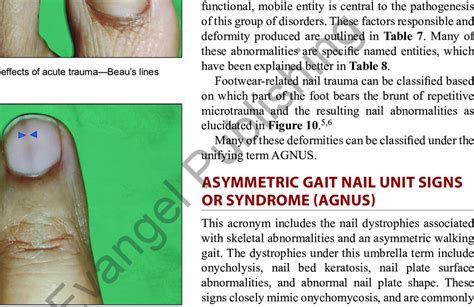 Delayed effects of acute trauma-Longitudinal melanonychia represented ...