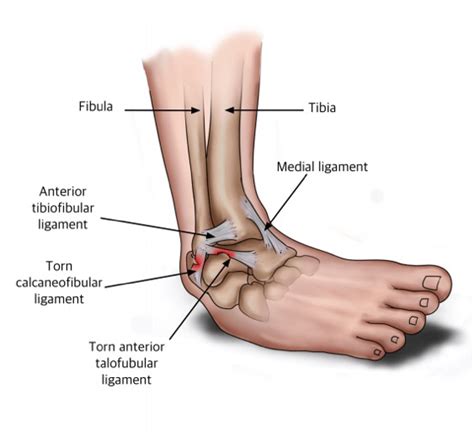 Ligaments torn in a Lateral Ankle Sprain - Ryde Natural Health Clinic