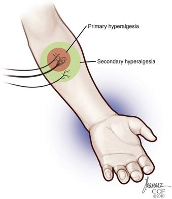 Pain in Spine Disease | Neupsy Key