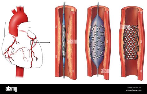 Coronary Artery Stent Placement