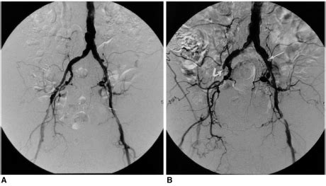 A 68-year-old male patient underwent left common iliac artery and ...