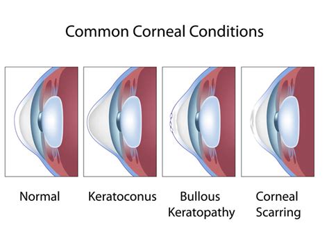 Cornea Diseases and Treatments | South East Eye