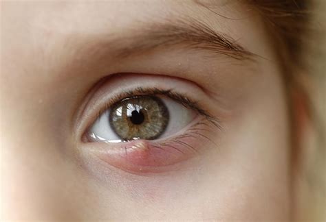 Stye in Child's Eye: Types, Causes, Signs, and Treatment