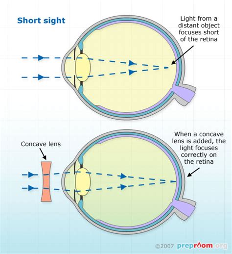 Short and Long Sight - Physics - Printer Friendly Page - Preproom.org