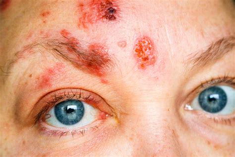 What Does Shingles Look Like? Shingles Rash Pictures