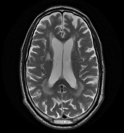 Diffuse brain atrophy in a hypertensive patient. Axial T2WI shows ...