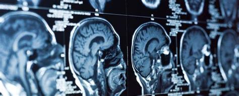 CT scan (computed tomography imaging) information | myVMC