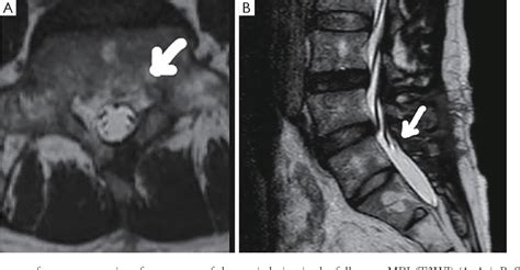 Subacute hemorrhagic cyst of the ligamentum flavum occurred in the ...