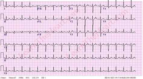 Sinus Tachycardia ECG 1 | LearntheHeart.com