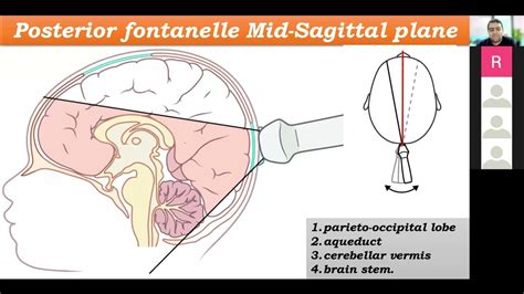 part 4 :: Neonatal Cranial sonography:: Posterior fontanelle planes ...