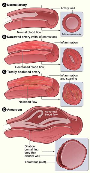 Vasculitis - Causes and Risk Factors | NHLBI, NIH