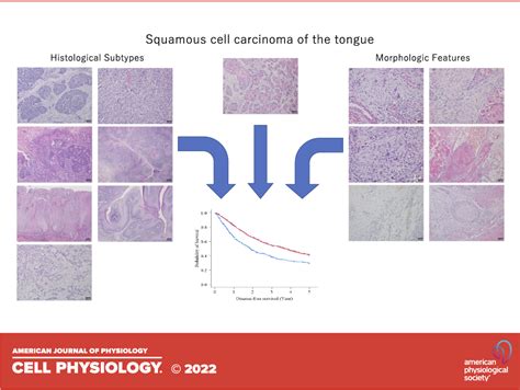 Squamous Cell Carcinoma Tongue Symptoms