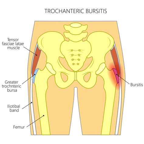 Hip Bursitis - Pro Motion Physiotherapy Thornhill