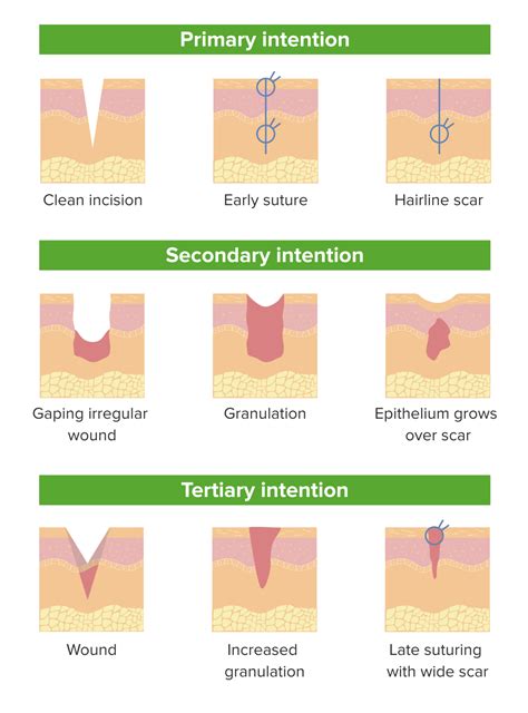 Wound Healing | Concise Medical Knowledge