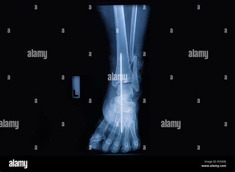 Fracture of the lower part of the fibula, front view X-ray Stock Photo ...