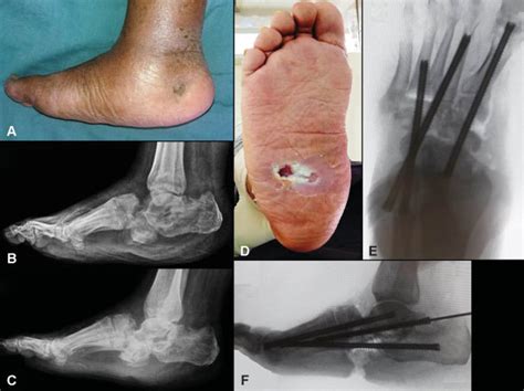 Symptoms Of Charcot Foot Disease