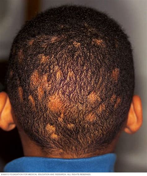 Ringworm (scalp) - Symptoms and causes - Mayo Clinic