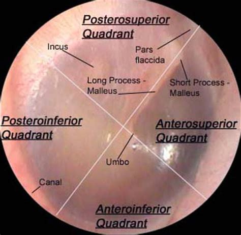 Tympanic Membrane Anatomy – Department of Pediatrics – UW–Madison