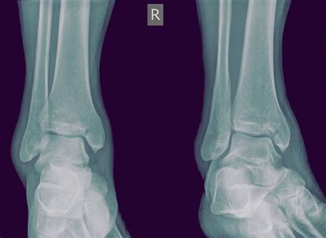 Fractures of the Inner Side of the Ankle Joint | Ankle joint, Broken ...