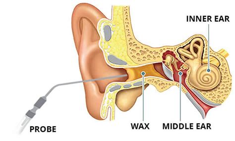 Microsuction Ear Wax Removal: Expert Guidance and Recommended Clinic