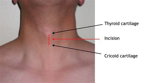 Emergency battlefield cricothyrotomy | CMAJ