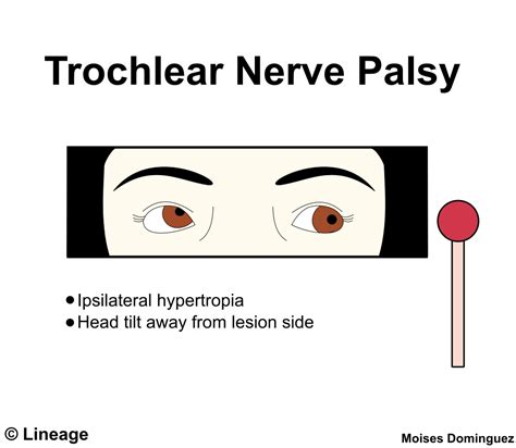 Cranial Nerve Palsies - Neurology - Medbullets Step 2/3