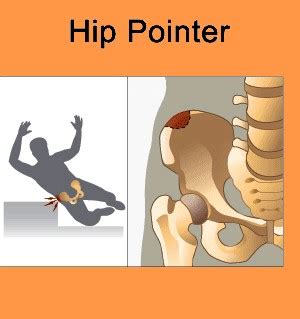 Types Of Hip Pointer