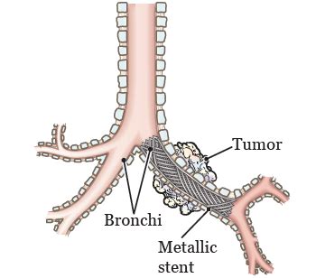 Tracheal or Bronchial Stent Placement | Memorial Sloan Kettering Cancer ...