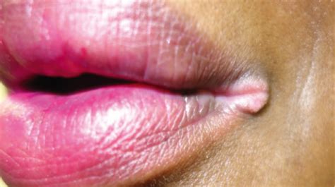 Lesions On Lips | Lipstutorial.org