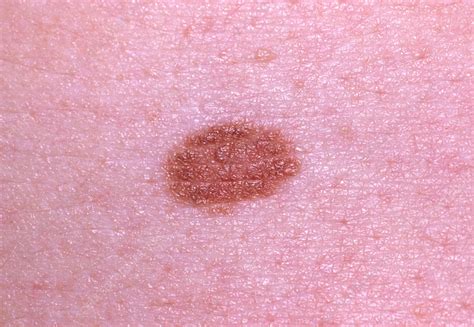 Close-up of benign melanocytic naevus (mole) - Stock Image - M220/0096 ...